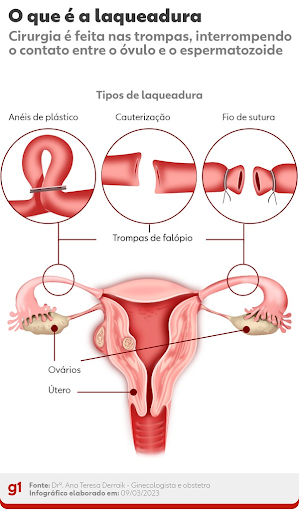 Tipos de laqueadura - Reprodução: G1